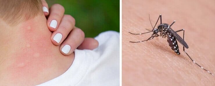 punture-di-zanzare